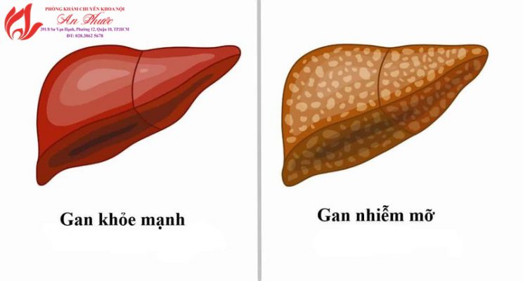 Bệnh gan nhiễm mỡ