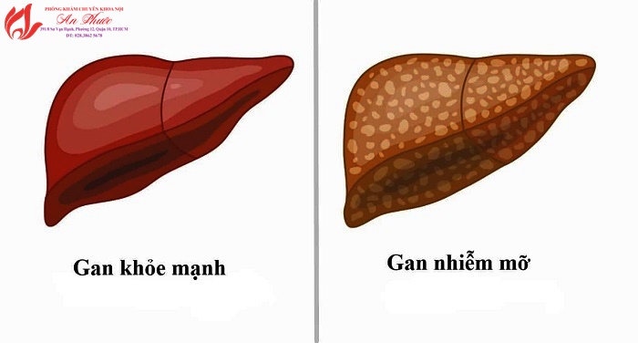 Gan nhiễm mỡ là gì?