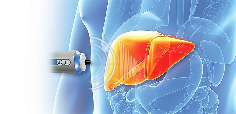 FibroScan là gì?