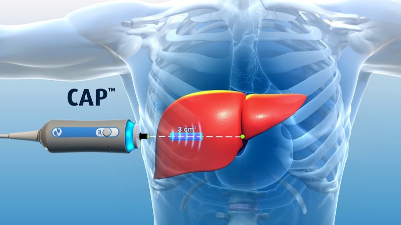 Nguyên tắc hoạt động của FibroScan là gì?