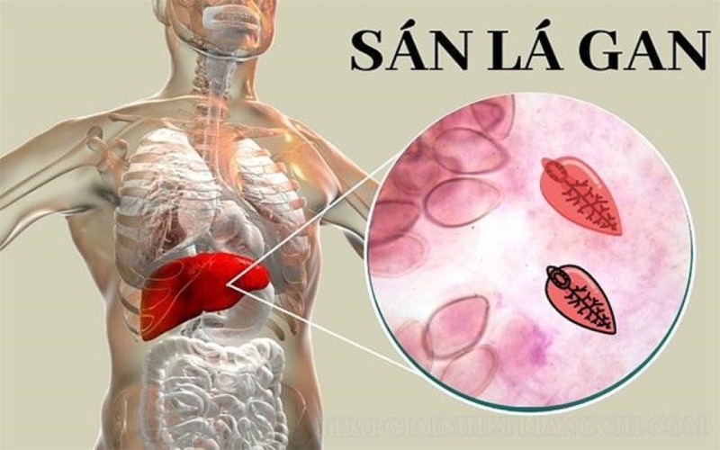 Bệnh sán lá gan là gì? Triệu chứng và cách phòng ngừa hiệu quả