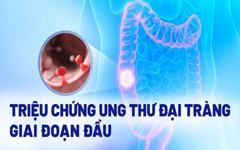 Triệu chứng ung thư đại tràng và cách điều trị