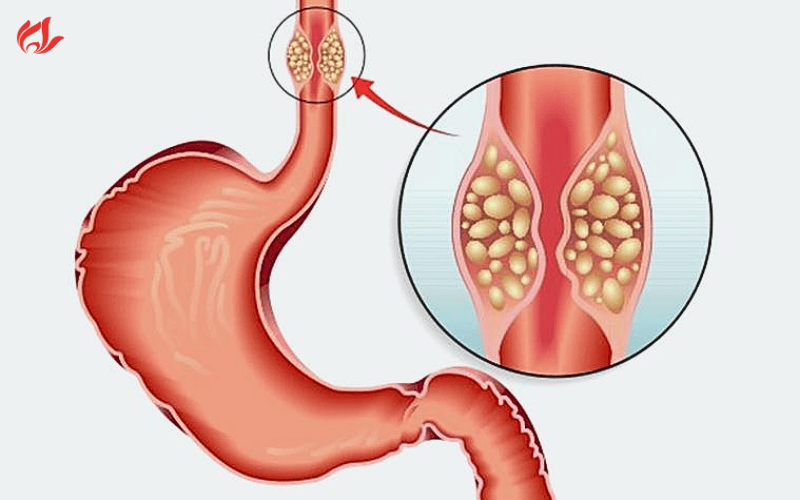 Các yếu tố làm tăng nguy cơ ung thư thực quản