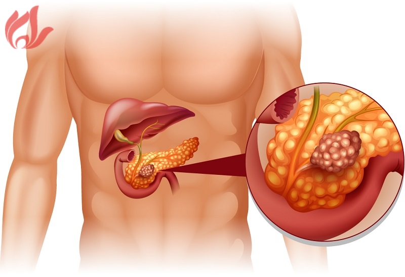 Triệu chứng nhận biết ung thư tuyến tụy sớm