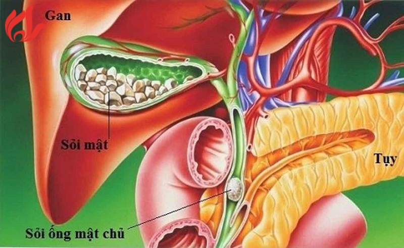 Sỏi mật là gì?