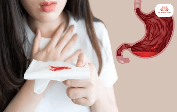 Dấu hiệu cảnh báo xuất huyết dạ dày