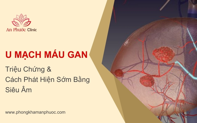Triệu chứng của u mạch máu gan và cách phát hiện sớm