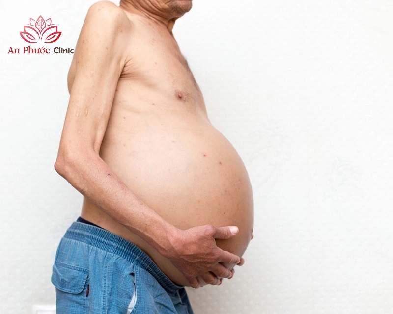 Các dấu hiệu cảnh báo ung thư dạ dày di căn