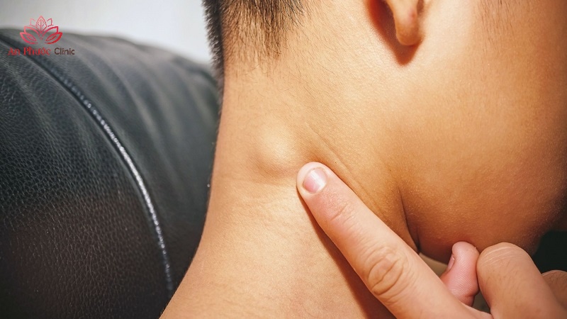 Dấu hiệu cảnh báo bị ung thư dạ dày di căn