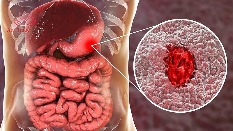 Viêm niêm mạc dạ dày là gì?