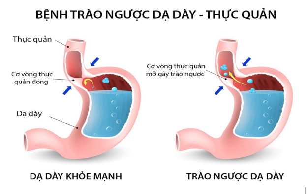 bệnh trào ngược dạ dày