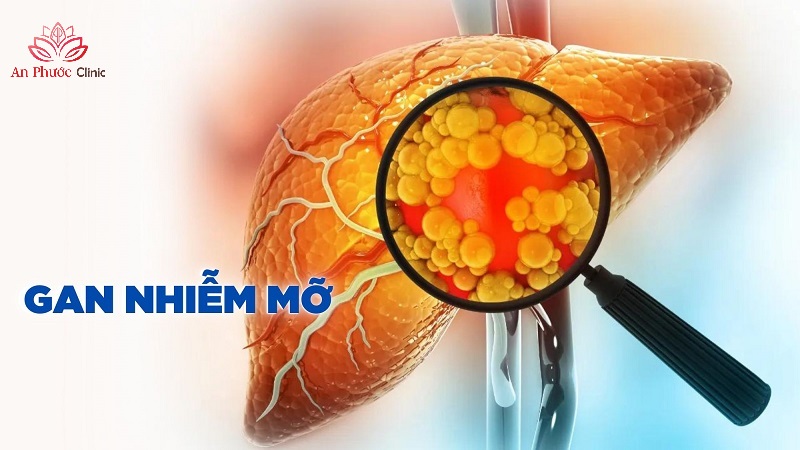 Bệnh gan nhiễm mỡ là gì?