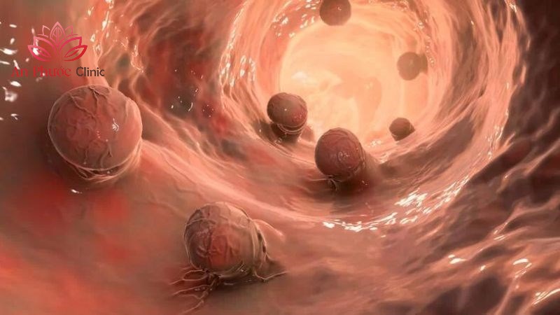Polyp dạ dày là gì?