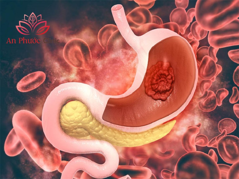 Nguy cơ biến chứng của polyp dạ dày