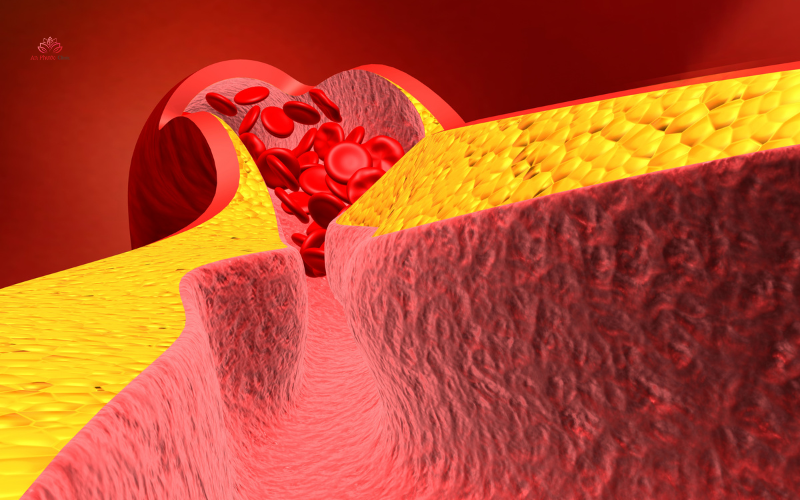 Mỡ máu cao là gì?