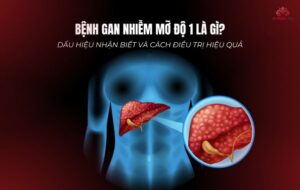 Bệnh gan nhiễm mỡ độ 1 là gì Dấu hiệu nhận biết và cách điều trị hiệu quả