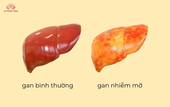 Gan nhiễm mỡ độ 1 là gì?