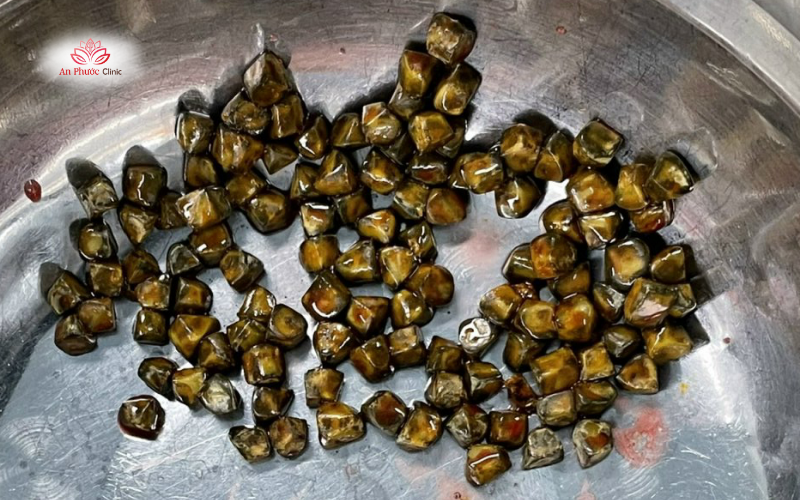 Hơn 100 viên sỏi mật được lấy ra từ túi mật