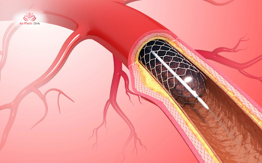 Minh họa phương pháp đặt stent nới rộng động mạch