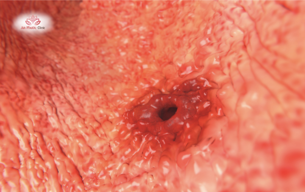 Viêm loét dạ dày cần phải đi khám