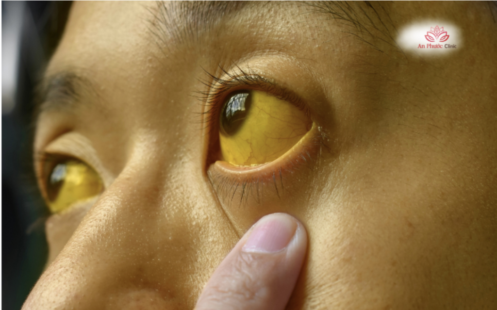 Vàng da thường xuất hiện kèm theo vàng tròng mắt