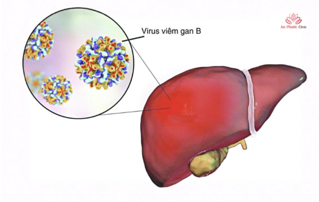 Viêm gan virus B