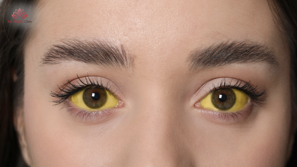 vàng mắt là dấu hiệu của bệnh gì