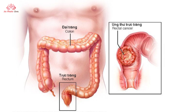 Ung thư đường tiêu hóa là gì?