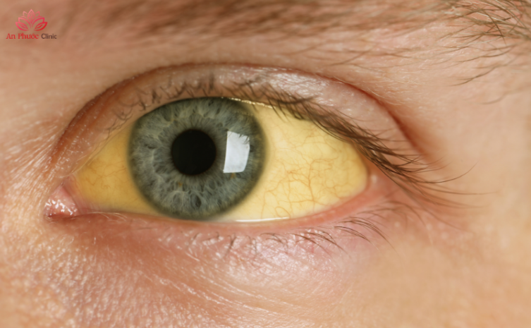 Dấu hiệu viêm gan do thuốc