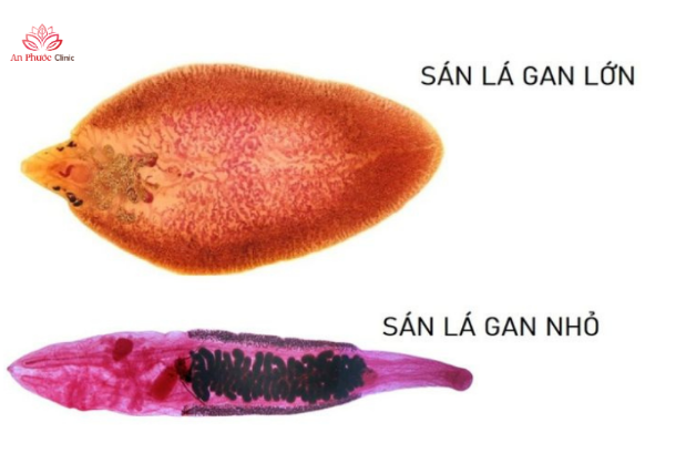 Phân biệt sán lá gan lớn và nhỏ giúp định hướng phác đồ điều trị chính xác
