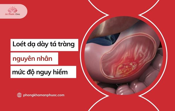 Loét dạ dày tá tràng là gì Nguyên nhân và mức độ nguy hiểm