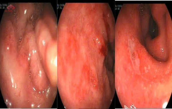 Loét dạ dày tá tràng là gì?