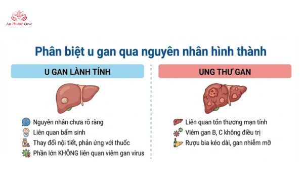 Phân biệt u gan qua nguyên nhân hình thành