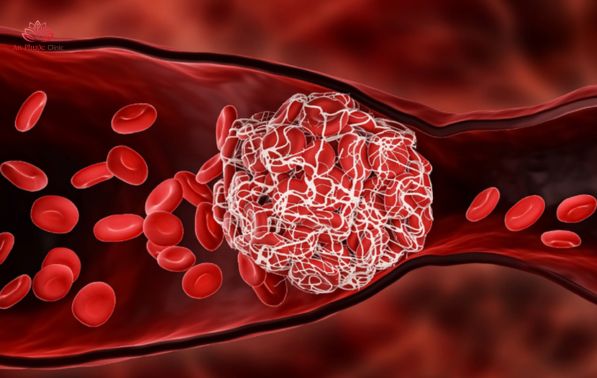 Rối loạn đông máu