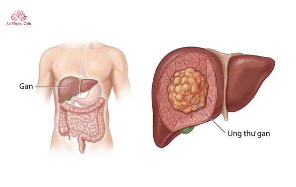 Ung thư gan là gì?