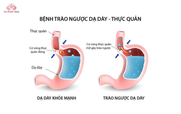 Vì sao trào ngược dạ dày lại gây khó thở?