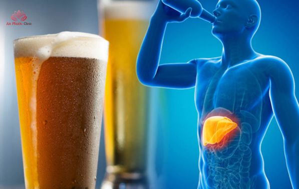 Viêm gan do rượu bia là gì?