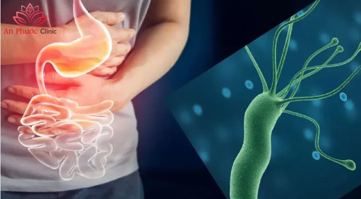 Vi khuẩn HP là gì?