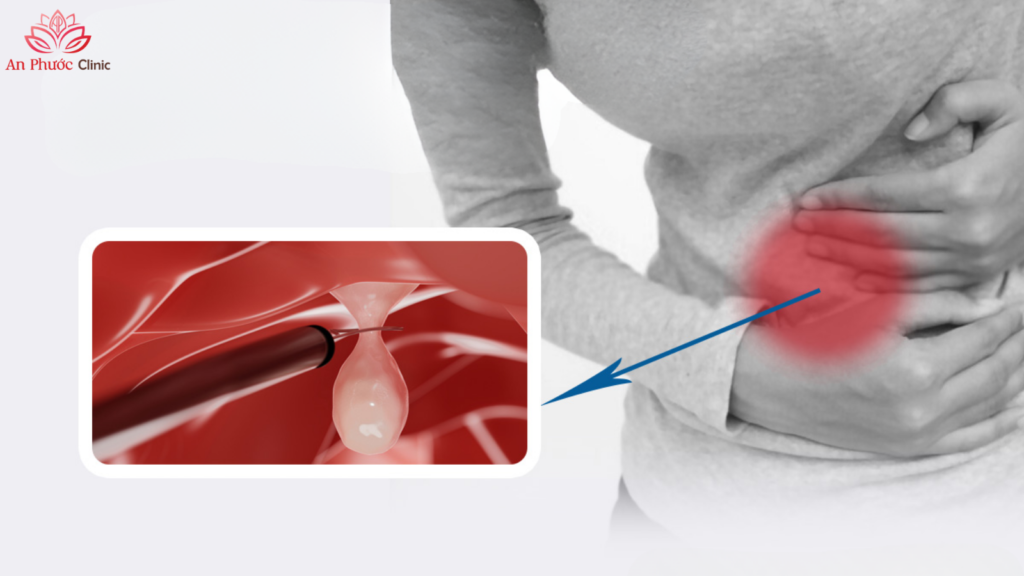 Polyp đại tràng là 1 trong những bệnh lý liên quan