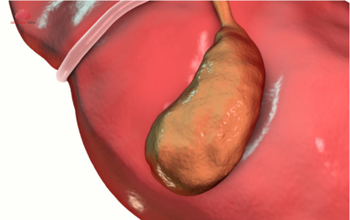 Các bệnh lý về túi mật và đường mật