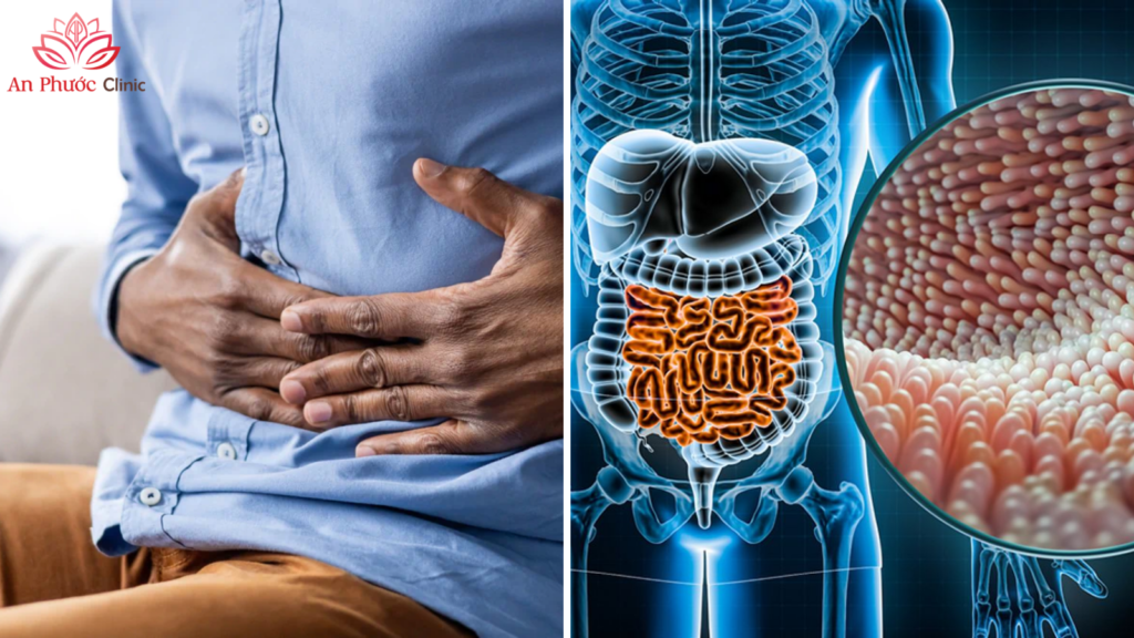 Viêm ruột non có thể gây đau bụng quanh rốn và tiêu chảy