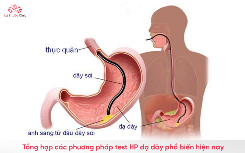 Phương pháp test HP dạ dày
