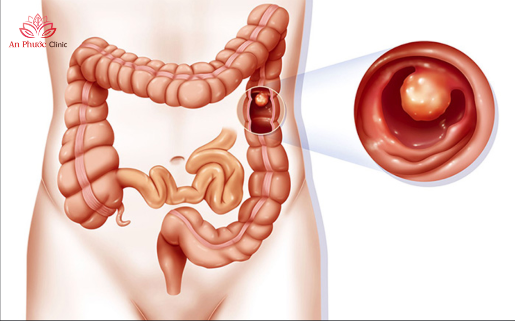 Các yếu tố ảnh hưởng đến chi phí cắt polyp đại tràng