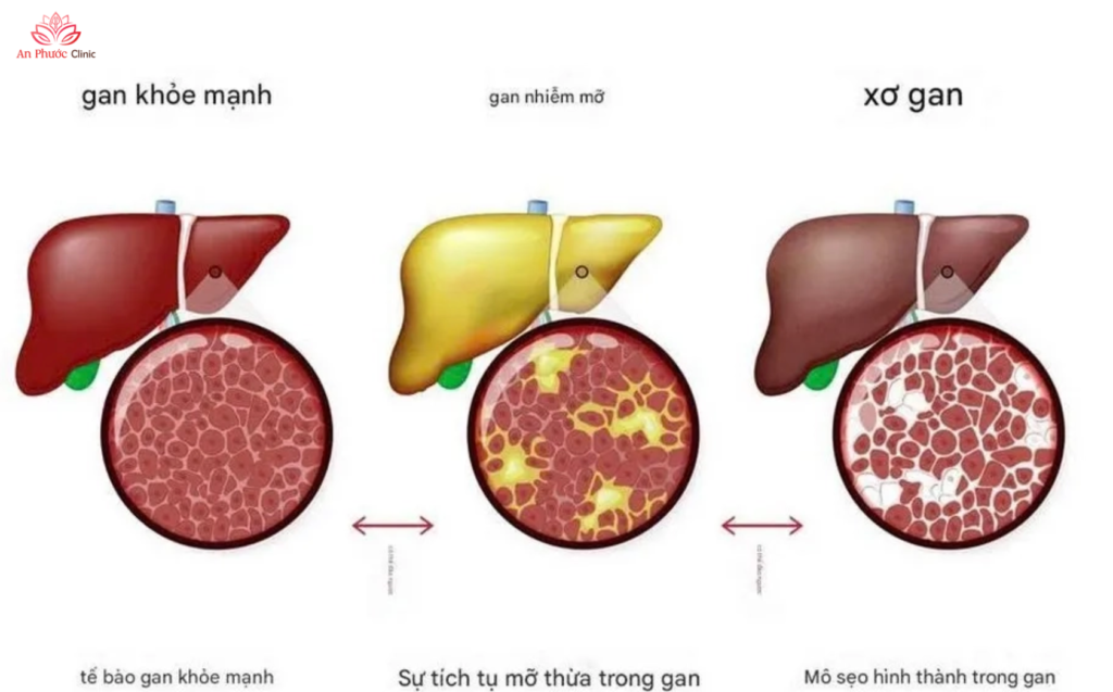 Mức độ bệnh gan nhiễm mỡ