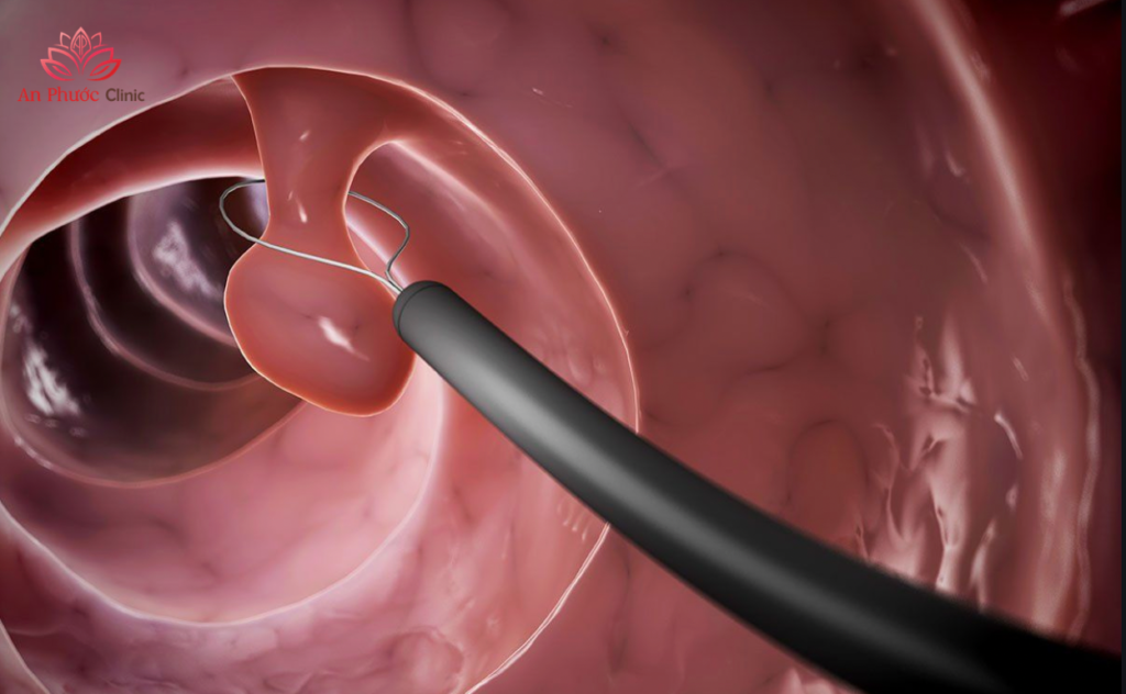 Cắt polyp đại tràng