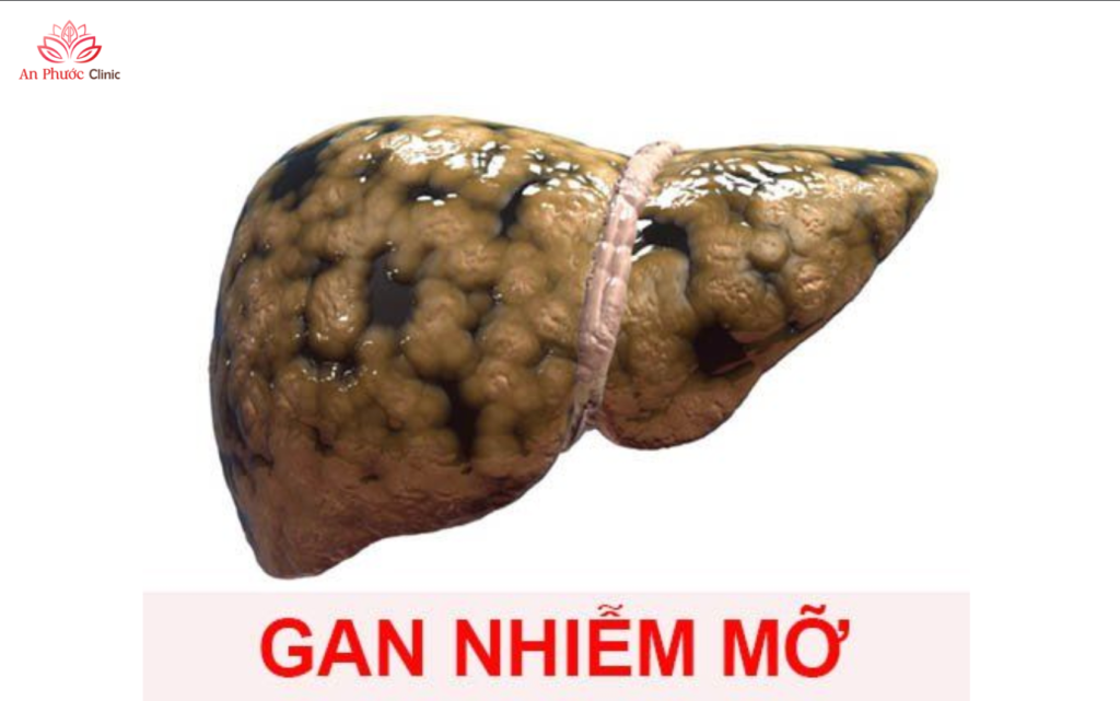 Tại sao cần biết cách theo dõi gan nhiễm mỡ đúng cách?