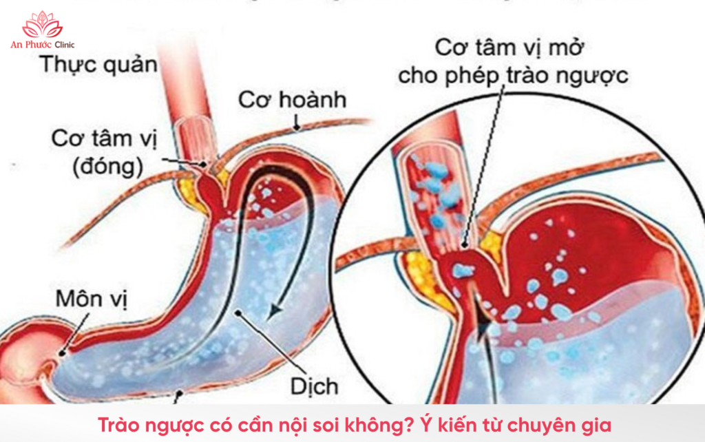 Trào ngược dạ dày thực quản